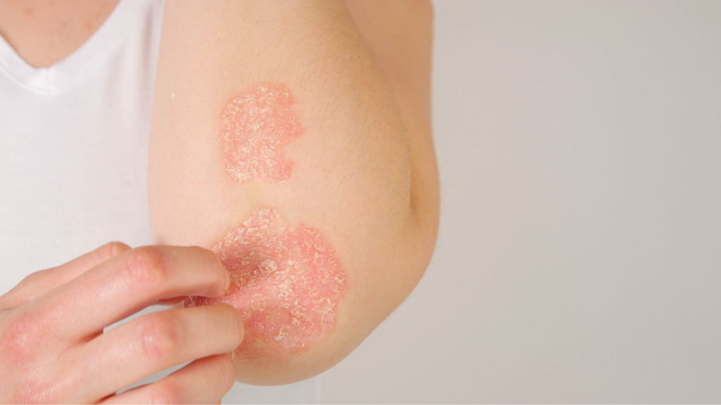 luminothérapie LED psoriasis eczema