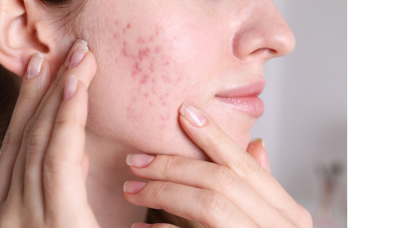 luminothérapie LED acne
